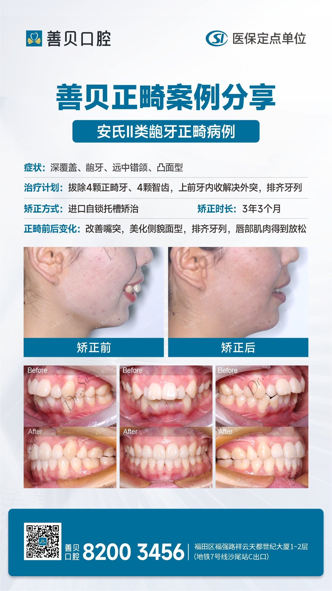 <a href='http://hk.szsbck.com' target='_blank'><u>深圳箍牙</u></a>醫院推薦